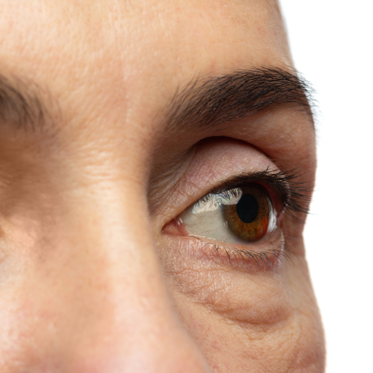 Eyebags+Dark Eye Circle