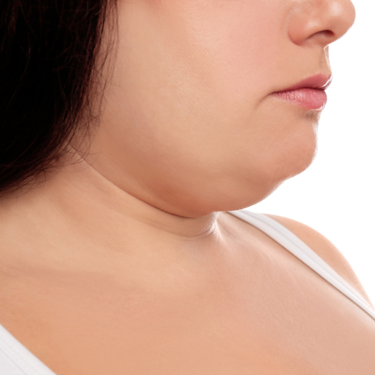 Neck+Jawlines+Double Chin