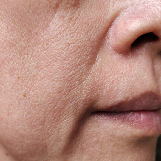 Smile Lines+Mouth Wrinkles